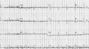 EKG Cihazlarında Parazitlenmeyi Önlemek İçin 3 Altın Kural EKG Cihazlarında Parazitlenmeyi Önlemek İçin 3 Altın Kural