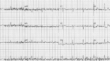 EKG Cihazlarında Parazitlenmeyi Önlemek İçin 3 Altın Kural