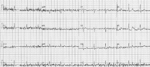 EKG Cihazlarında Parazitlenmeyi Önlemek İçin 3 Altın Kural EKG Cihazlarında Parazitlenmeyi Önlemek İçin 3 Altın Kural