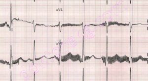 EKG Cihazlarında Parazitlenmeyi Önlemek İçin Neler Yapılmalı?