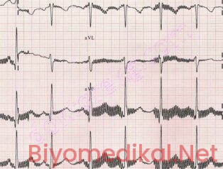 EKG Cihazlarında Parazitlenmeyi Önlemek İçin Neler Yapılmalı?