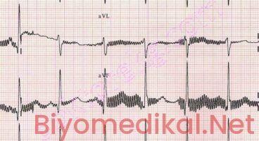 EKG Cihazlarında Parazitlenmeyi Önlemek İçin Neler Yapılmalı?
