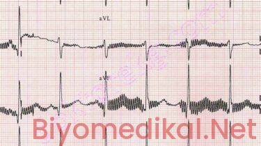 EKG Cihazlarında Parazitlenmeyi Önlemek İçin Neler Yapılmalı?