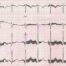 EKG Cihazlarında Parazitlenmeyi Önlemek İçin Neler Yapılmalı?
